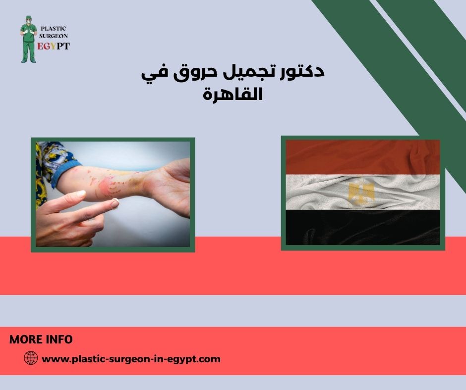 دكتور تجميل حروق في القاهرة
